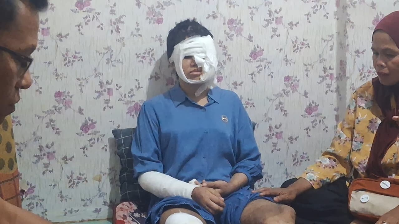 Kondisi korban penyiksaan orang tua angkat. (Foto: Muhammad SJ)
